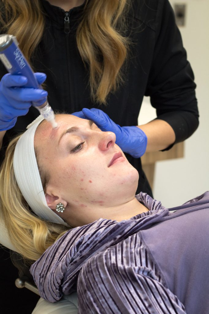 I tried it: A review of my microneedling treatments at Sistine Plastic Surgery in Pittsburgh. Microneedling is a skincare procedure that has been praised for its anti-aging benefits and is also known to help with hyperpigmentation. Read the post to read more on microneedling for acne scars and if it worked for me.