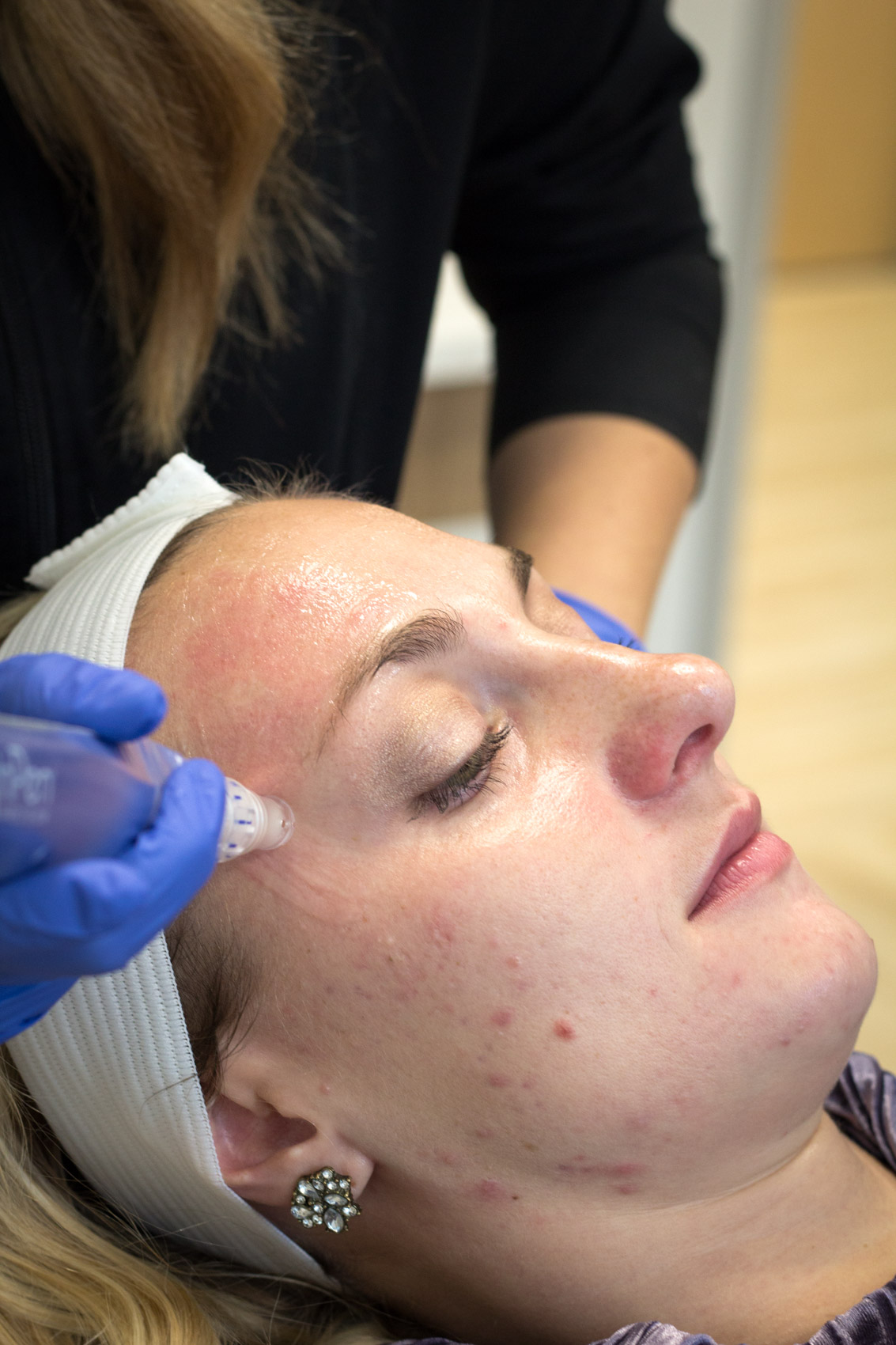 I tried it: A review of my microneedling treatments at Sistine Plastic Surgery in Pittsburgh. Microneedling is a skincare procedure that has been praised for its anti-aging benefits and is also known to help with hyperpigmentation. Read the post to find out more on microneedling for acne scars and if it worked for me. 