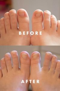 Kerasal Multi-Purpose Nail Repair Review Before & After Photo